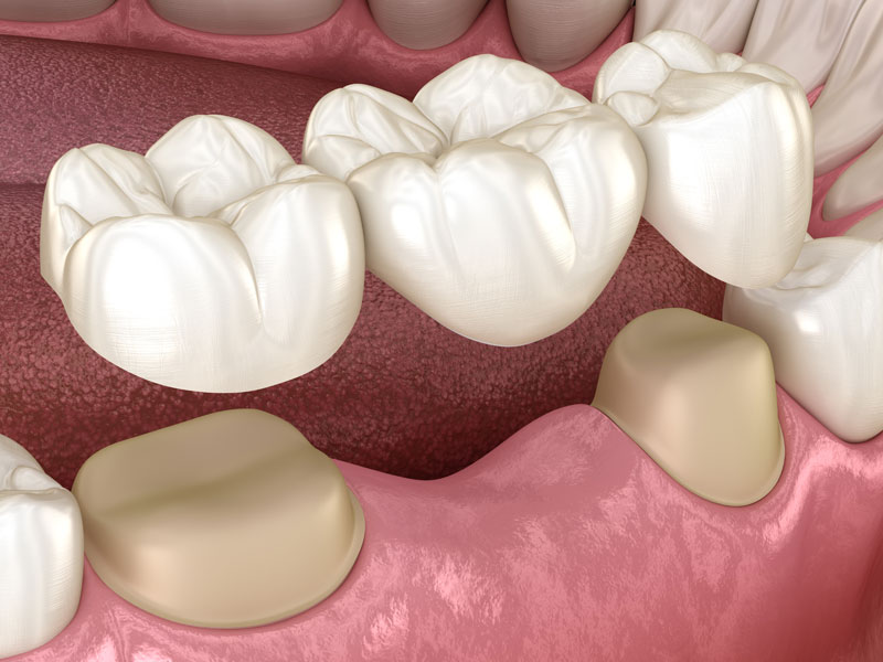 dental bridge model Tavares, FL