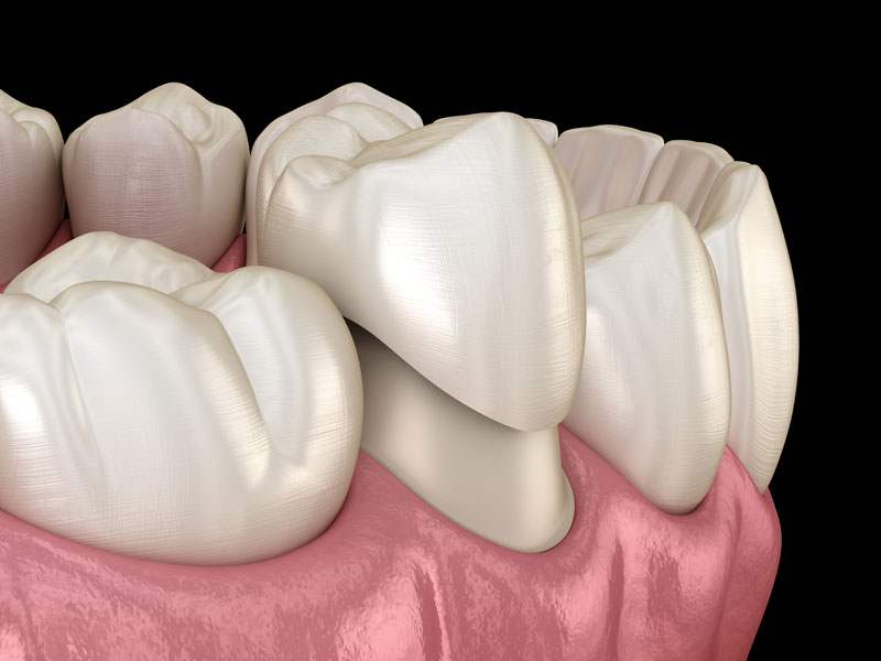 dental crown model Tavares, FL