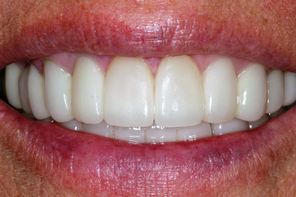 Smile Gallery Tavares, FL Lakeview Dentistry