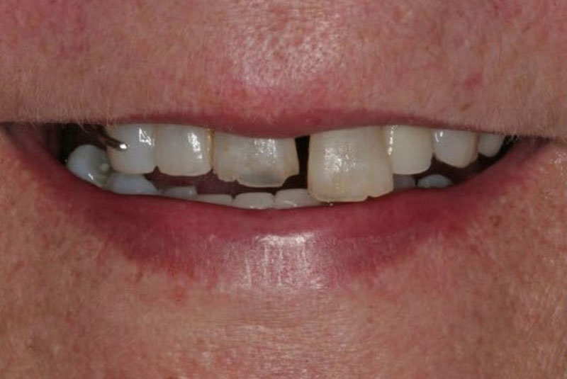 Before