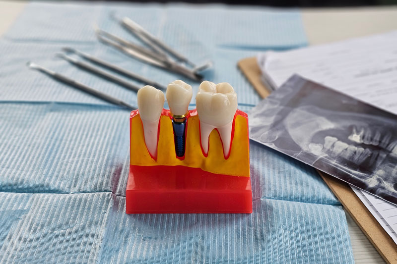 Dental implant, artificial tooth roots into jaw, root canal of dental treatment, gum disease, teeth model for dentist