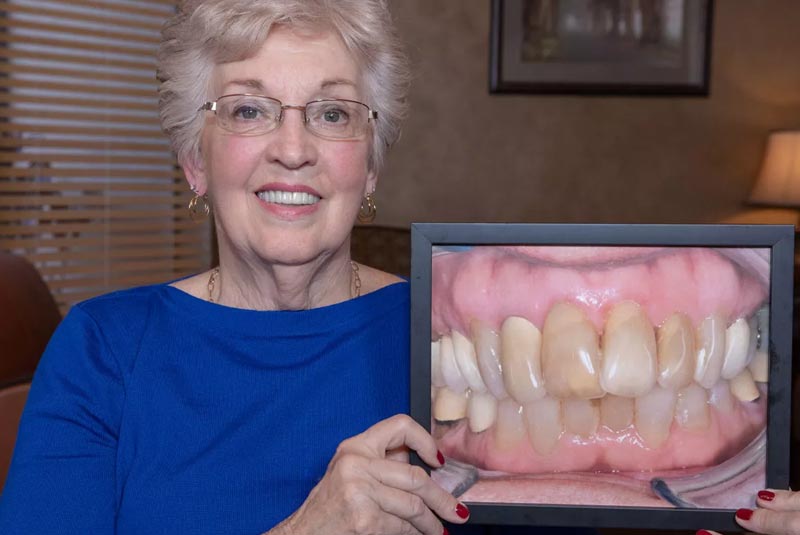 full arch dental implants patient smiling after procedure Tavares, FL